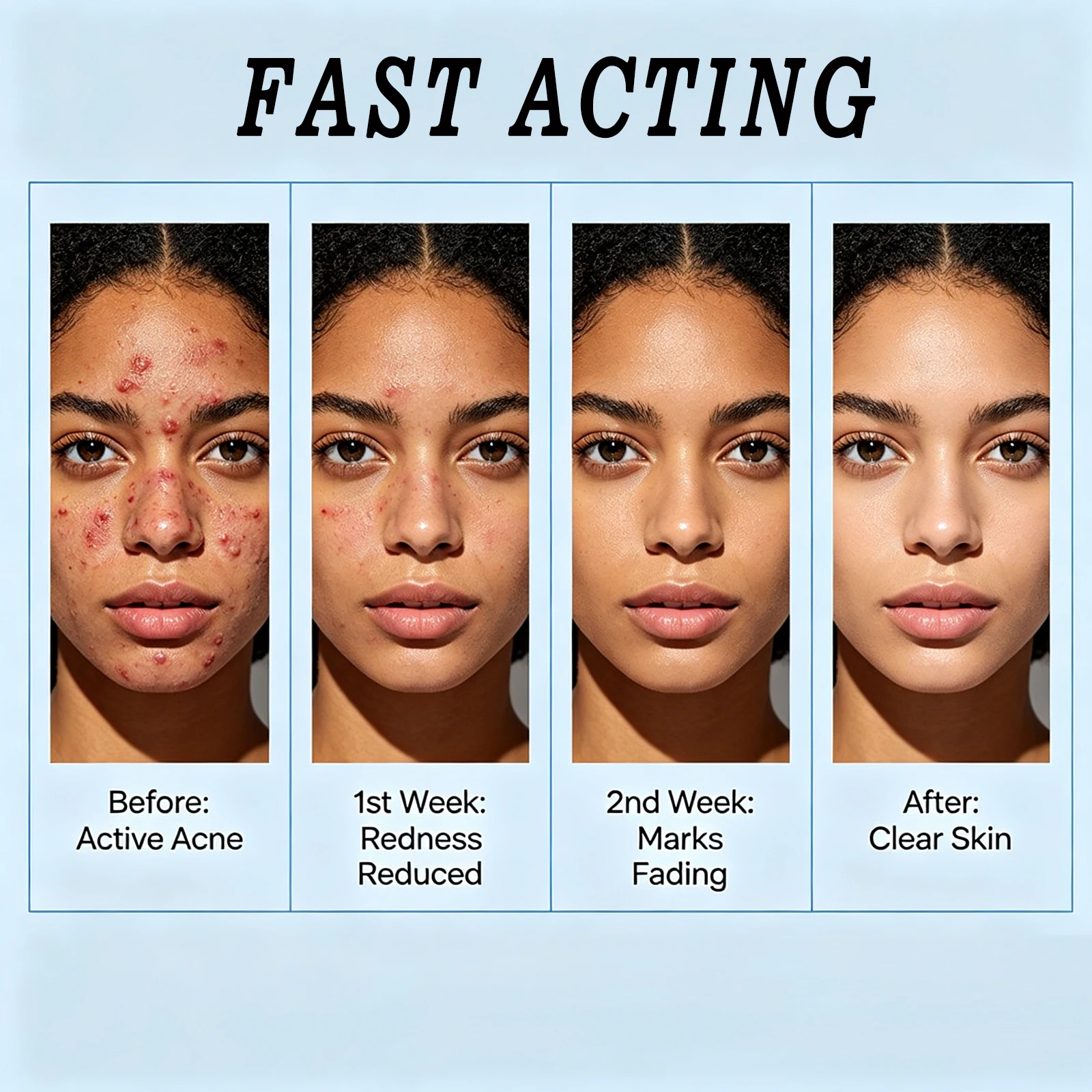 Crème Anti-Acné Acide Salicylique – Efface Cicatrices, Taches & Resserre les Pores